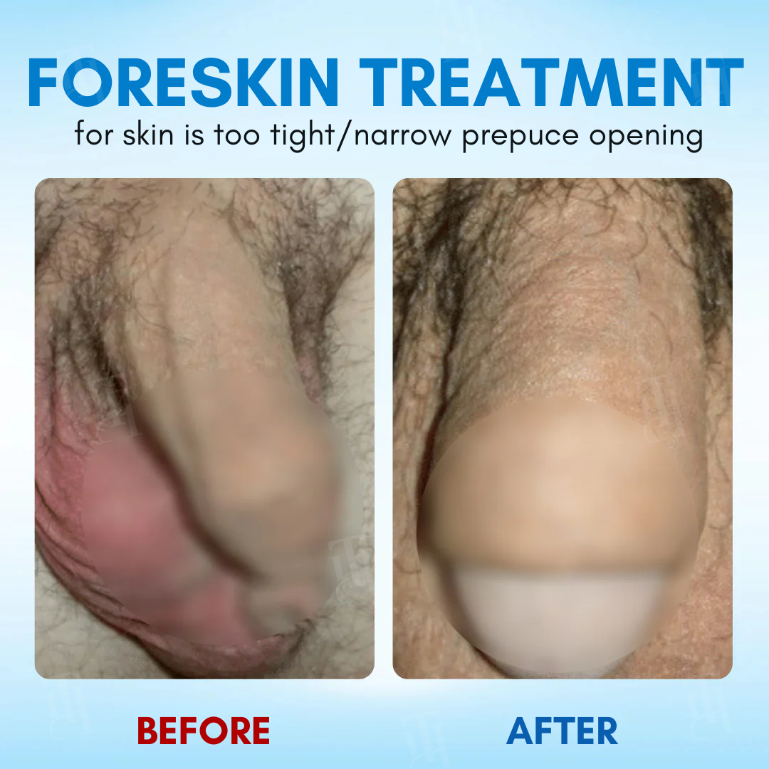 ⚡RZXEA™ Foreskin Elasticity Gel: Restore Your Edge, Restart Your Vitality.