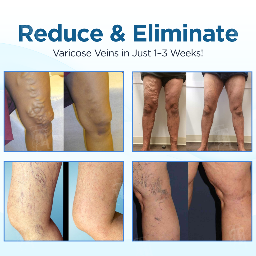 Cvreoz® Herbal Varicose Veins Treatment Spray：48-Hour Light Legs