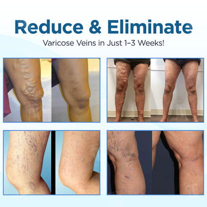 Cvreoz® Herbal Varicose Veins Treatment Spray：48-Hour Light Legs