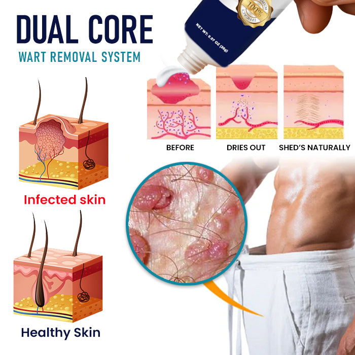 🌟 Official Store | 🛡️ Painless Removal in Just 14 Days! Clinical-Grade Sensitive Formula. RZXEA™ Genital Warts Remover Cream