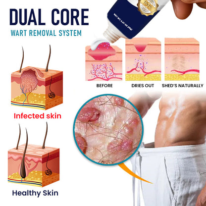 🌟 Official Store | 🛡️ Painless Removal in Just 14 Days! Clinical-Grade Sensitive Formula. RZXEA™ Genital Warts Remover Cream