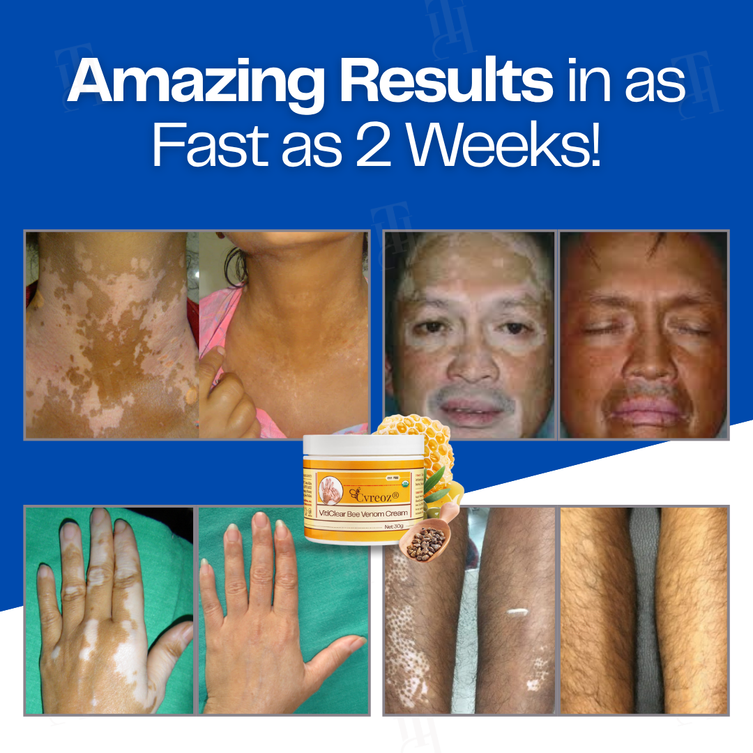 Limited Stock!! RZXEA™ VitiClear Bee Venom Cream