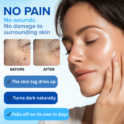 Mresio®  Skin Tag Removal Kit