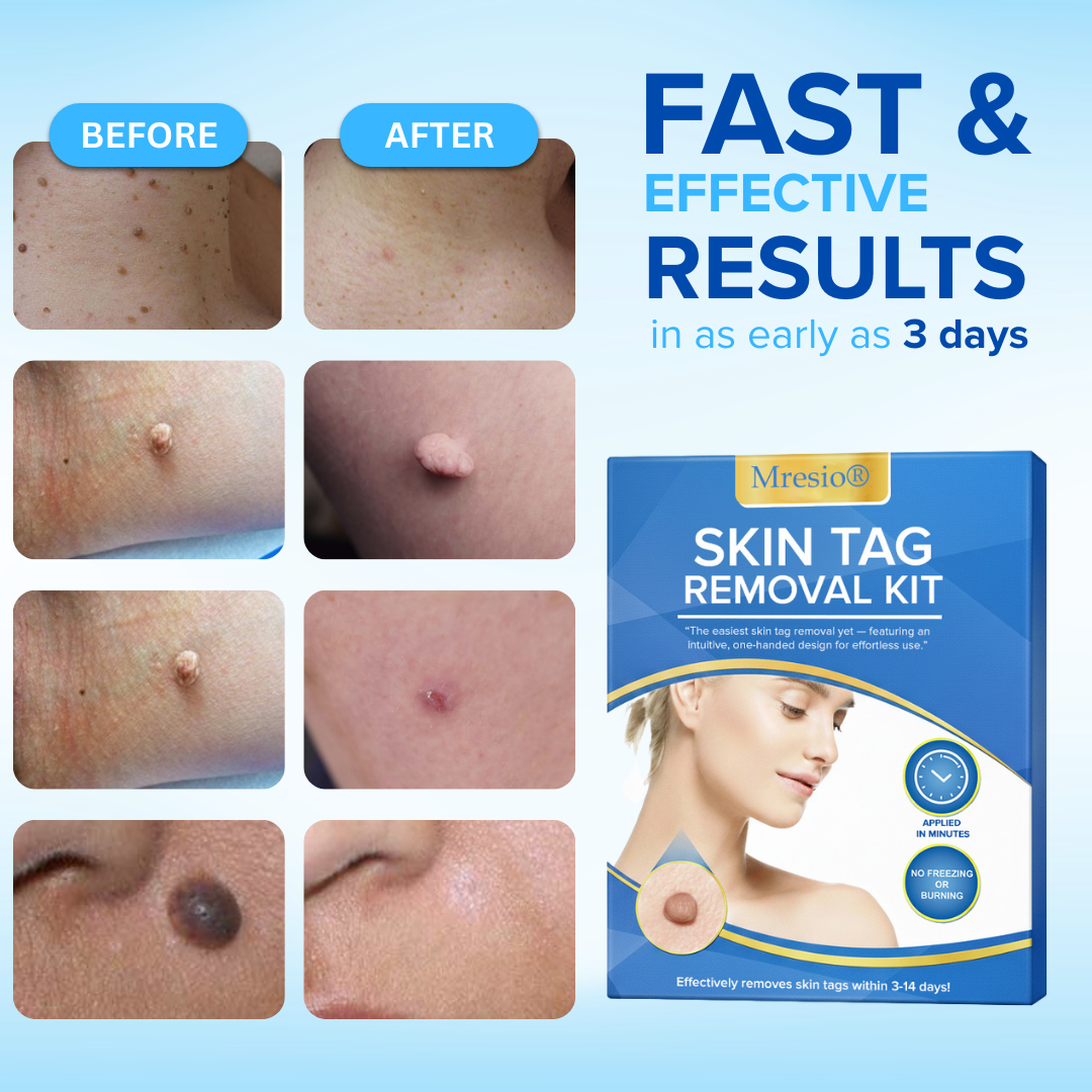 Mresio®  Skin Tag Removal Kit