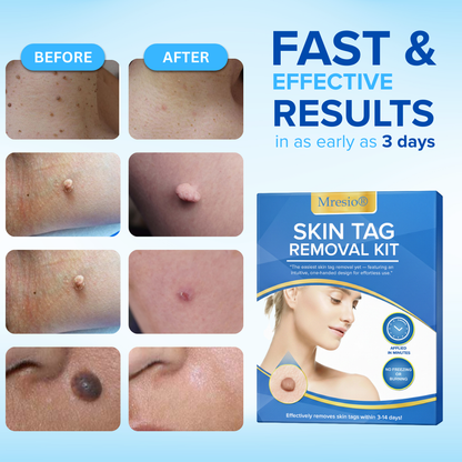 Mresio®  Skin Tag Removal Kit