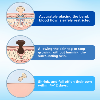 Mresio®  Skin Tag Removal Kit