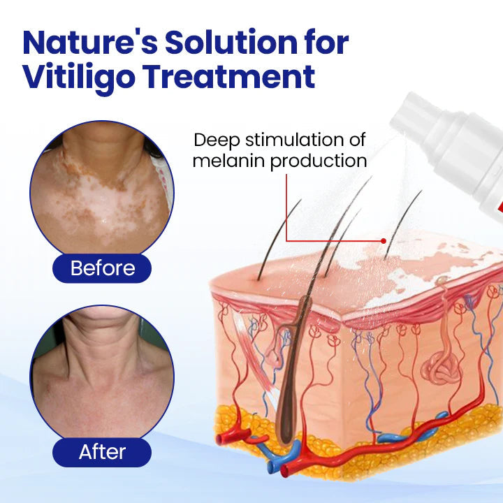 RZXEA™ Vitiligo Treatment Spray