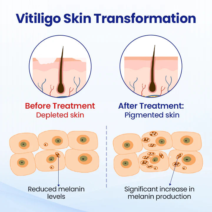 RZXEA™ Vitiligo Treatment Spray