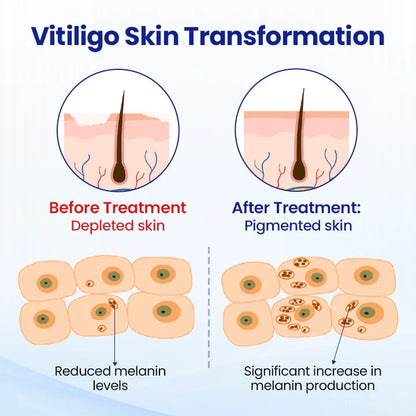 RZXEA™ Vitiligo Treatment Spray