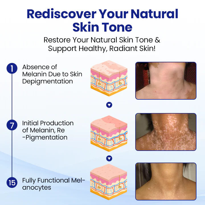 RZXEA™ Vitiligo Treatment Spray