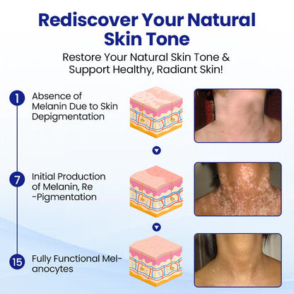 RZXEA™ Vitiligo Treatment Spray